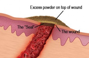 wound seal on wound diagram